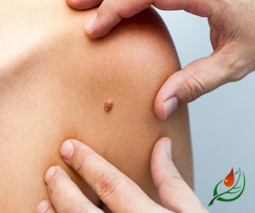 Вирус папилломы человека